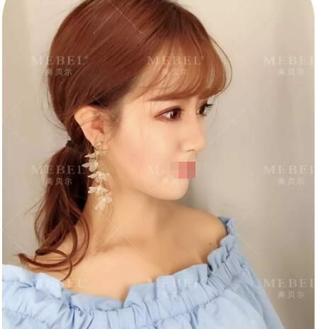 担心去眼袋恢复慢会反弹?扬州美贝尔真人体验分享祛眼袋为首的眼综合+鼻综合前后10天蜕变心路历程 图2