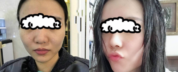 讲述我在西宁韩美做硅胶+耳软骨隆鼻的真实感受,并附鼻综合术后1-7天的照片