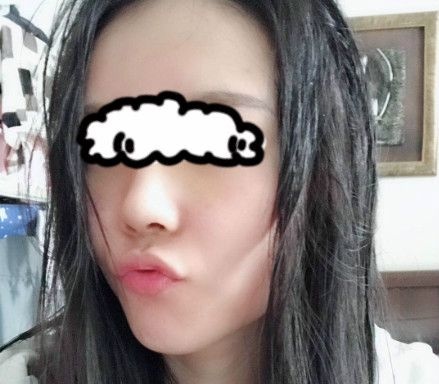讲述我在西宁韩美做硅胶+耳软骨隆鼻的真实感受,并附鼻综合术后1-7天的照片 图2