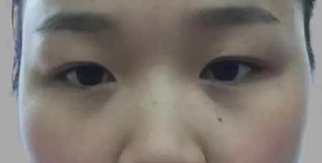 案例记录:我找呼和浩特华美整形医院张晓刚做假体隆鼻和自体耳软骨隆鼻手术的价格是12800元