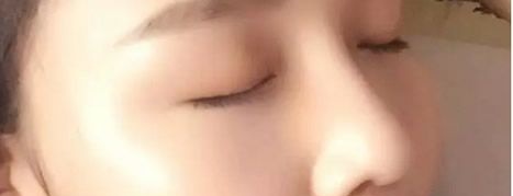 案例记录:我找呼和浩特华美整形医院张晓刚做假体隆鼻和自体耳软骨隆鼻手术的价格是12800元 图2