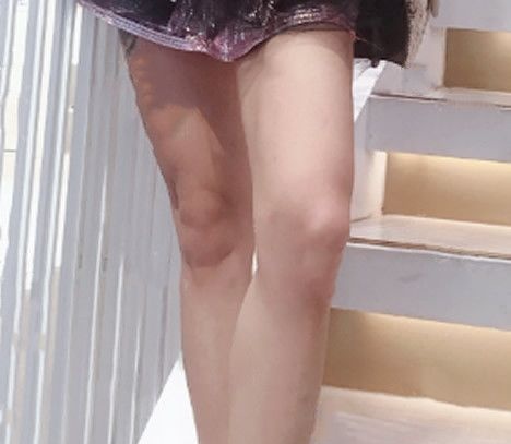 我找呼和浩特华美王志军大腿吸脂2年没反弹 闺蜜找华美张晓刚做自体脂肪面部填充效果也很自然 图2