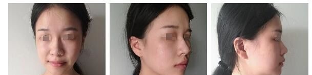 纠结后选择南通俪人连天美医生推荐线雕改善垮掉的脸和法令纹