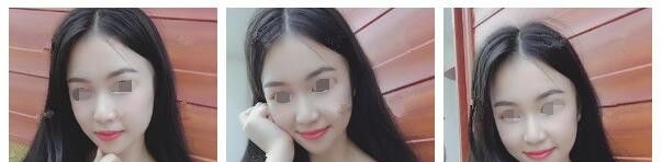 纠结后选择南通俪人连天美医生推荐线雕改善垮掉的脸和法令纹 图2