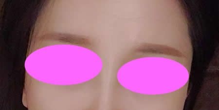 大家看我找吉安天使王小辉花9800块做的肋骨鼻综合三个月效果好不好 图2