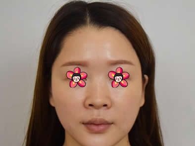 提前半个月电话预约终于约到嘉兴禾美医院曹海峰院长做了万和硅胶假体隆鼻和耳软骨垫鼻尖综合手术