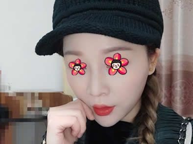 提前半个月电话预约终于约到嘉兴禾美医院曹海峰院长做了万和硅胶假体隆鼻和耳软骨垫鼻尖综合手术 图2