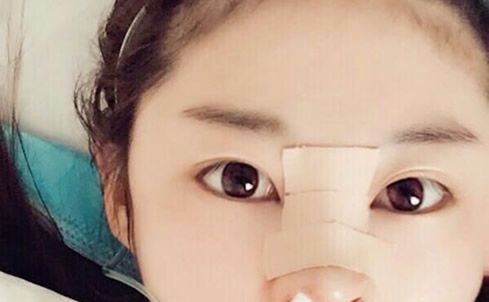 看过呼和浩特五洲鼻整形失败修复价格和真人案例 七天前我找王焕做了自体肋软骨隆鼻手术