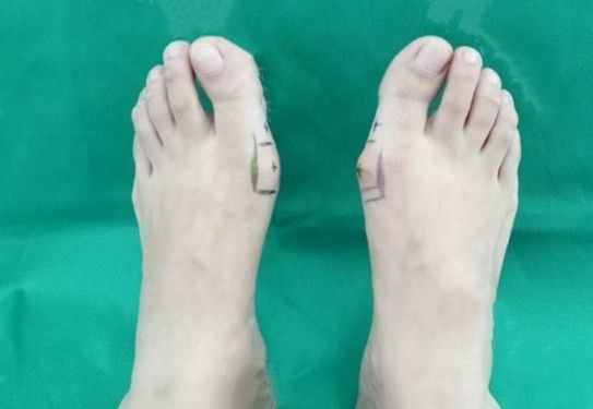 包头哪家医院拇指外翻手术做的好 看包头华美朱云给我做大脚骨整形手术前后效果对比图