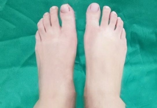 包头哪家医院拇指外翻手术做的好 看包头华美朱云给我做大脚骨整形手术前后效果对比图 图2