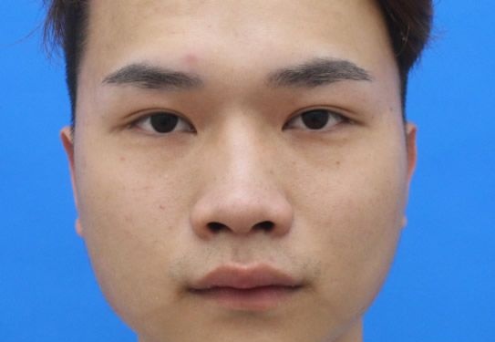 男生隆鼻要多少钱效果怎么样 包头华美白虎医生男生自体肋软骨隆鼻前后对比照片和价格可参考