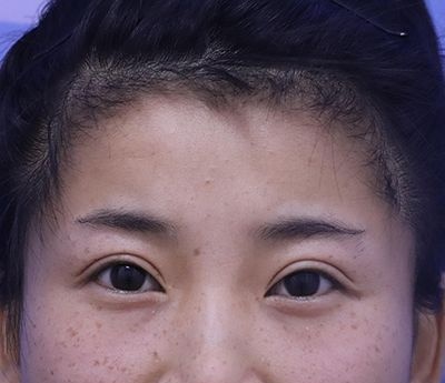 找哈尔滨臻美专注眼鼻修复的王丹丹做双眼皮修复后，明白了适合自己的才更好