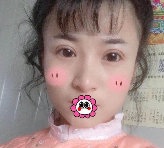找哈尔滨臻美专注眼鼻修复的王丹丹做双眼皮修复后,明白了适合自己的才更好 图2