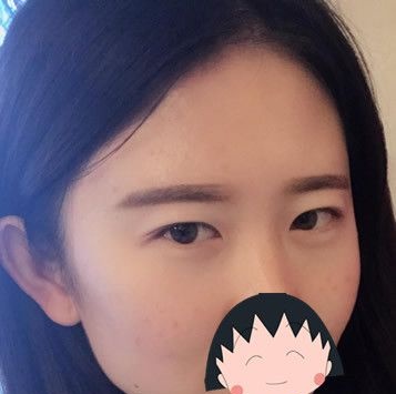 包头华美和叶子哪个好?割双眼皮前我真的好纠结,大家猜我在哪家医院做的?