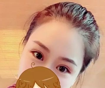 包头华美和叶子哪个好?割双眼皮前我真的好纠结,大家猜我在哪家医院做的? 图2