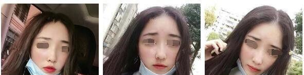 三个月蜕变自然氧气少女脸的秘诀是在南通俪人连天美做了肿胀轻恢复的自体脂肪面部填充+假体隆鼻 图2