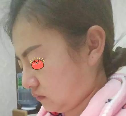 这是一份我在永康光大整形医院做过光纤溶脂瘦脸的体验报告,希望不要反弹效果能持久