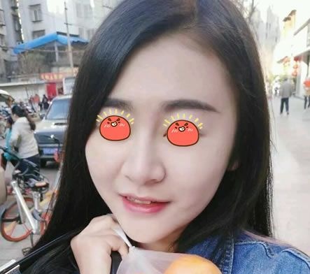 这是一份我在永康光大整形医院做过光纤溶脂瘦脸的体验报告,希望不要反弹效果能持久 图2