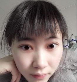 我皮肤不好,长痘痘,毛孔也大,直到去遵义韩美做了opt激光去雀斑变这样! 图2