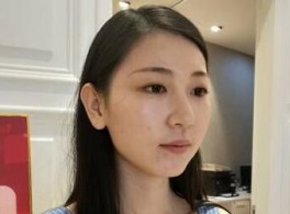 我在遵义韩美做这个取颊脂垫+面部吸脂手术是全麻的,感觉就是睡了个觉的工夫。
