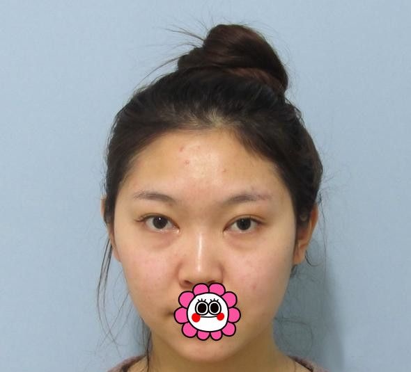 花了2800元在哈尔滨索菲找陈富全用硅胶垫下巴恢复三个月后秒变女神脸