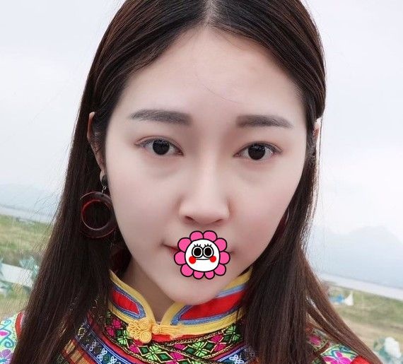 花了2800元在哈尔滨索菲找陈富全用硅胶垫下巴恢复三个月后秒变女神脸 图2