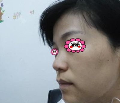 在湘潭雅美做完线雕的第三个月，趁着五一整形价格优惠又定了面部脂肪填充项目