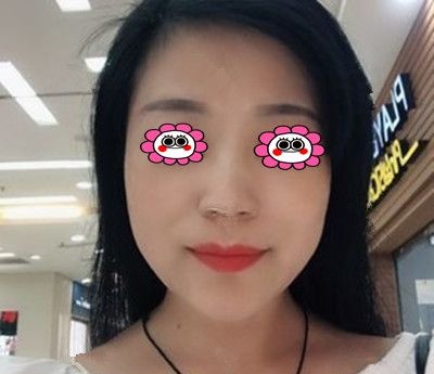 在湘潭雅美做完线雕的第三个月,趁着五一整形价格优惠又定了面部脂肪填充项目 图2