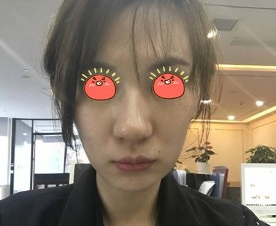 绍兴上虞一美整形的名气挺大的,看院长给我做的大腿吸脂和自体脂肪全脸填充效果怎么样