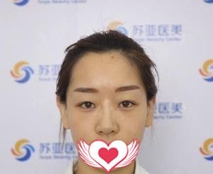 在唐山苏亚美联臣做4mm平行双眼皮+开内眼角两个月了 都说我的恢复效果很自然