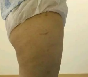 我刚在烟台做的大腿吸脂手术，我比较建议大家做全麻，大概就是五六千块吧