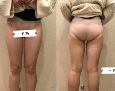 淄博美冠臣做大腿吸脂手术挺不错的,术后不会出现凹凸不平的现象