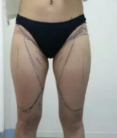 在威海做的大腿吸脂,65CM的腿围吸脂后瘦到57CM,我是一次就抽了3000CC