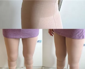 潍坊华美做全身吸脂手术挺好的，我做完腰腹、大腿和手臂恢复的也快