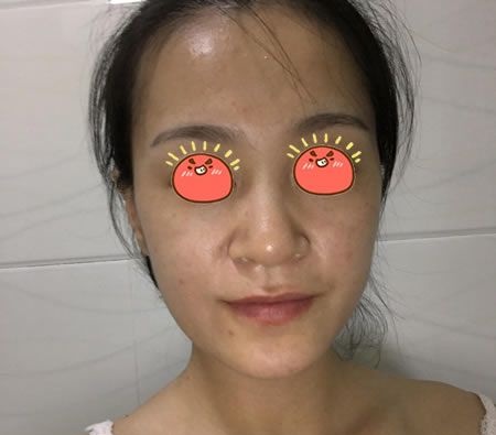 过完年在绍兴艺美做的硅胶假体隆鼻手术,现在把恢复3个月效果和价格分享给大家