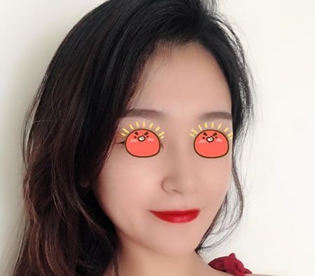 过完年在绍兴艺美做的硅胶假体隆鼻手术,现在把恢复3个月效果和价格分享给大家 图2