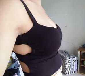 南宁隆胸哪家医院好?宝妈在华美整形做自体脂肪丰胸同时腰腹部也吸脂塑形啦 图2