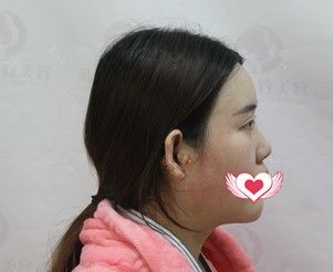 注射玻尿酸后我的鼻子变宽显得超丑 就找保定蓝山杜建龙做了艳冠假体隆鼻+耳软骨垫鼻尖后高挺鼻效果宛若天生
