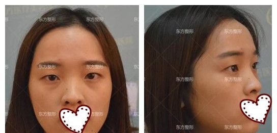  原本只是找南宁东方整形龙海波院长做肋软骨鼻综合隆鼻,面诊后又加了全切双眼皮