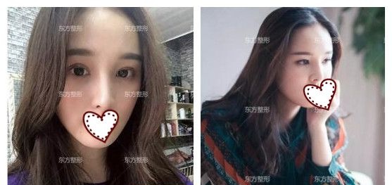 原本只是找南宁东方整形龙海波院长做肋软骨鼻综合隆鼻,面诊后又加了全切双眼皮 图2