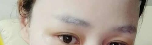 在吉安天使整形做仿生无痕双眼皮价格4800元,一个月后朋友都说效果和价格成正比 图2