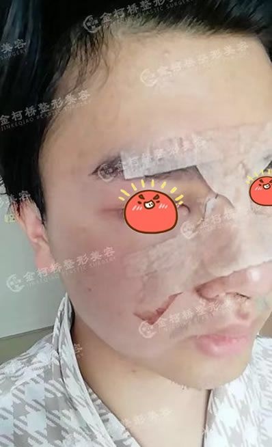 绍兴金柯桥医院陈树科做假体耳软骨隆鼻鼻子整形手术案例,记录一下恢复的过程