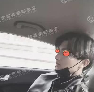 绍兴金柯桥医院陈树科做假体耳软骨隆鼻鼻子整形手术案例,记录一下恢复的过程 图2