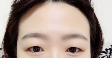 济南宝琳娜做双眼皮真不错,我在济南宝琳娜做了全切后恢复的挺快的