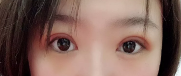 济南宝琳娜做双眼皮真不错,我在济南宝琳娜做了全切后恢复的挺快的 图2
