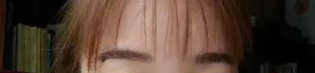 圆脸的我在宜春天泽医院找史希杰做了平行双眼皮,朋友都说形状和脸型格外的搭