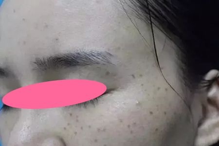 晒一下我去景德镇圣嘉丽整形做皮秒祛斑10天恢复过程图及效果