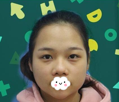 在内江达芬奇做了肋软骨鼻综合后,很多人夸我变美了,连同学看了都想要隆鼻了