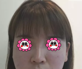 我是3月在淄博美冠臣做了面部吸脂手术,姐妹们可以参考一下哦