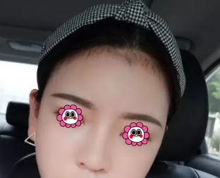 我是3月在淄博美冠臣做了面部吸脂手术,姐妹们可以参考一下哦 图2